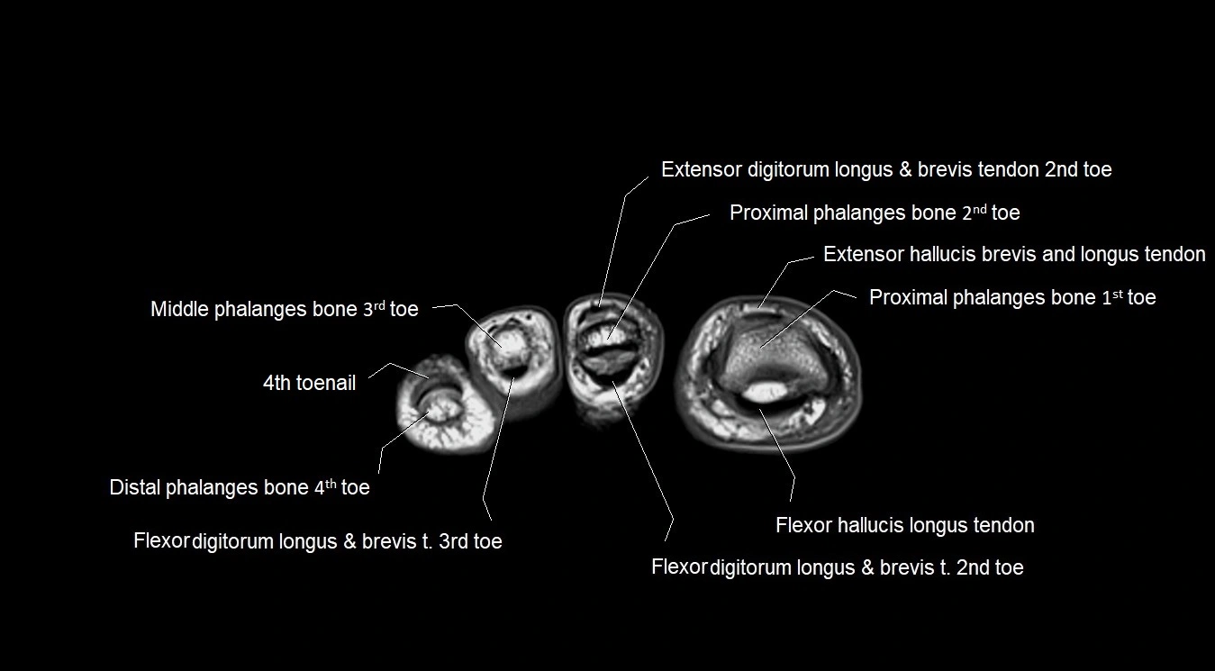 MRI 3T foot axial cross sectional anatomy image 37.webp